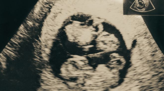 Dream About Seeing Twins on Ultrasound